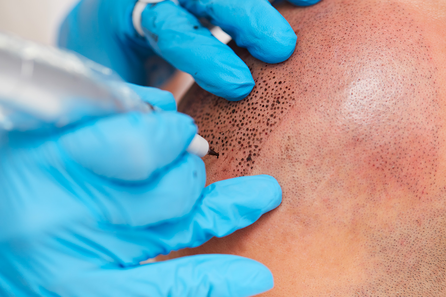 FAQ tricopigmentazione: Primo piano di una sessione di tricopigmentazione con operatore professionista che applica pigmenti sul cuoio capelluto.