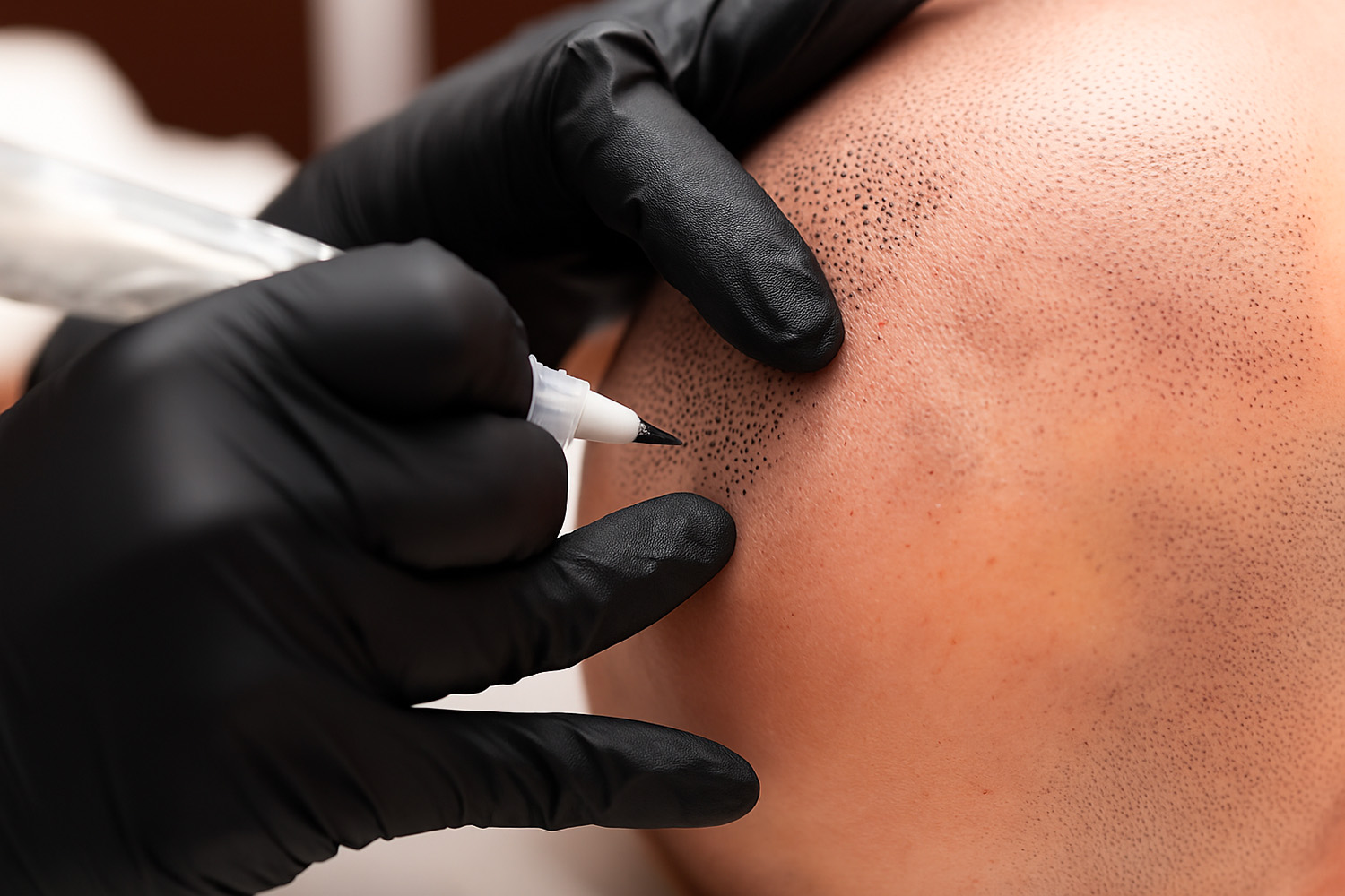 Seduta di tricopigmentazione effetto rasato, esempio visivo per capire quando fare tricopigmentazione