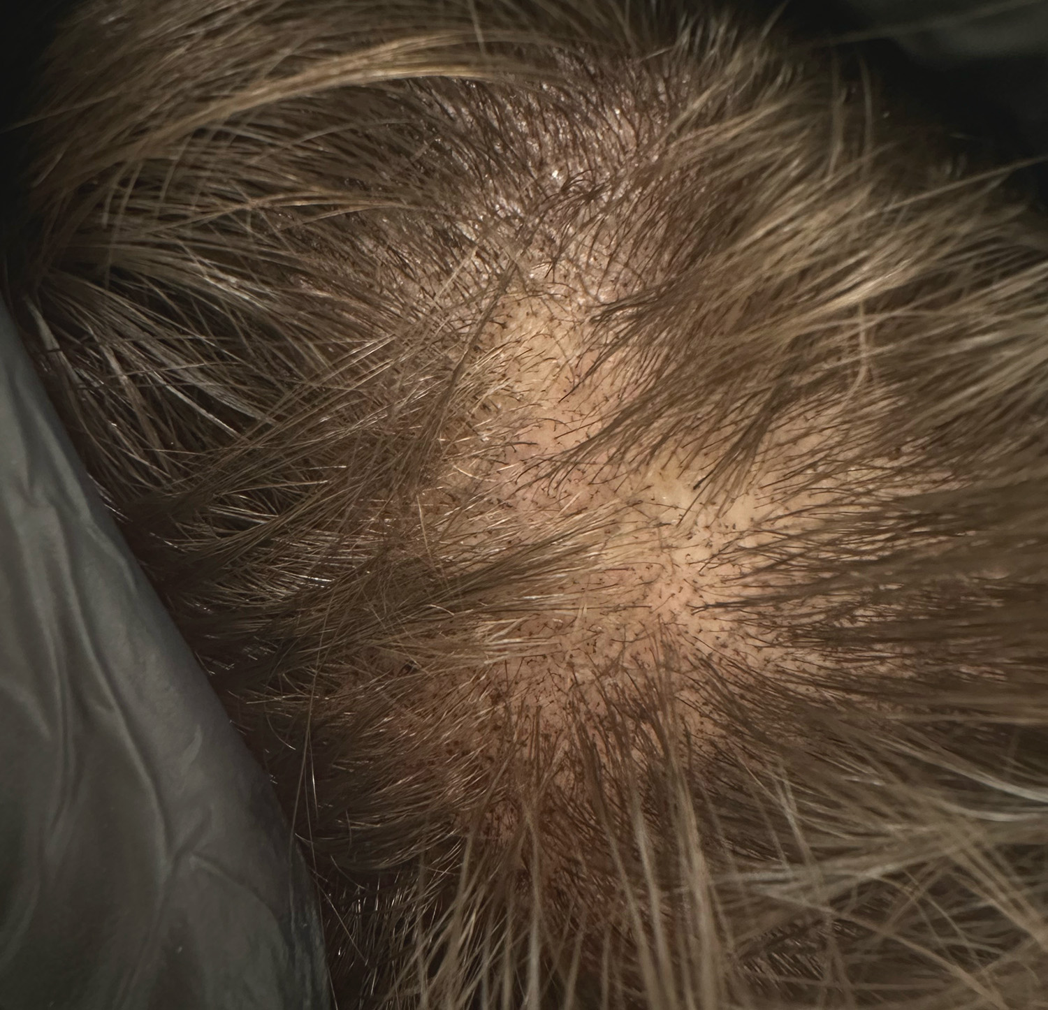 Cuoio capelluto con effetto densità visibile dopo una seduta di effetto densità tricopigmentazione.